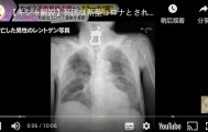 日本82岁老人喉咙痛被确诊新冠病死， X光发现是钥匙卡喉咙